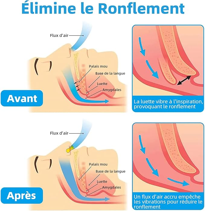 Dispositif anti ronflement pour hommes et femmes